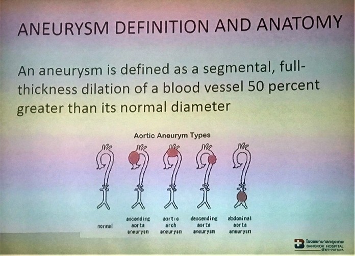 Dr. Sujit Banyatpiyaphod displayed this slide as he described what an Abdominal Aortic Aneurysm is and the types that can occur.