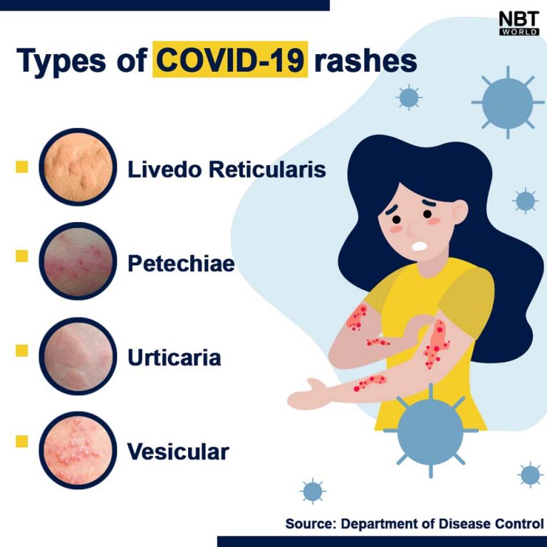 Thai DDC informs 4 kinds of skin rashes associated with coronavirus ...